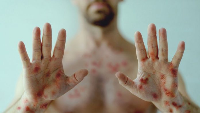 parana-casos-monkeypox-variola-dos-macacos-sintomas-tratamento.jpeg