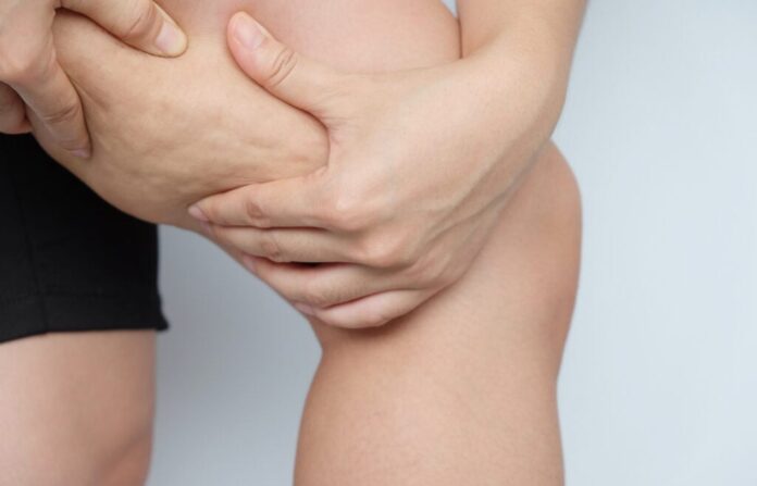 Estratégias para diminuir a celulite