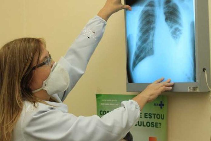 Tuberculose causa mais de 1,2 milhão de mortes em 2024, aponta relatório da OMS