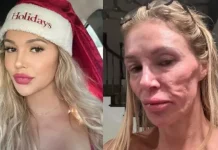 Ex-modelo que teve rosto ‘derretido’ revela origem da doença